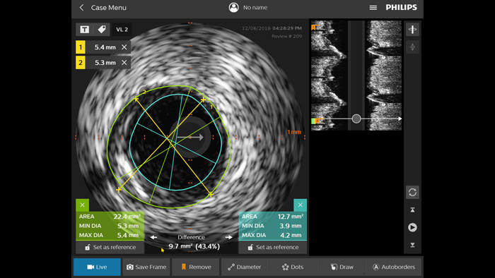 Ecograf&iacute;a intravascular (EIV)