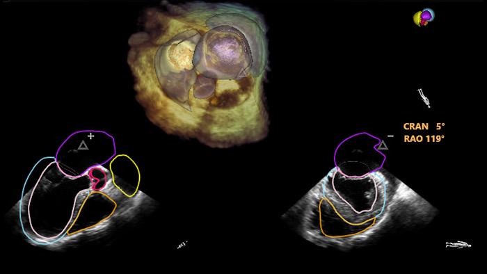Superposici&oacute;n completa de modelos 3D de EchoNavigator AI