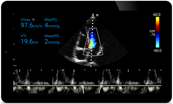 Act&uacute;e m&aacute;s r&aacute;pido para proteger su coraz&oacute;n
